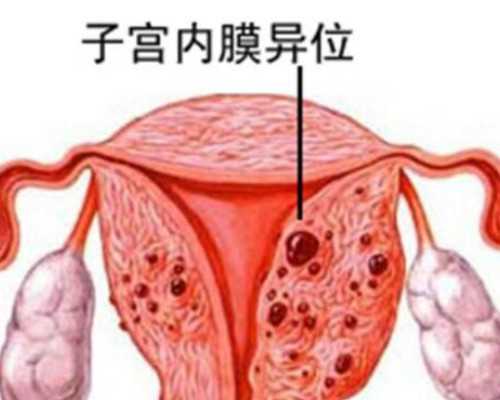 习惯性流产原因_女人怀孕子宫切除,闭经，卵巢早衰能做试管婴儿吗？【闭经，